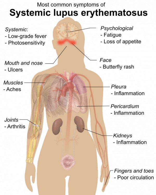 Types of Lupus Skin Symptoms