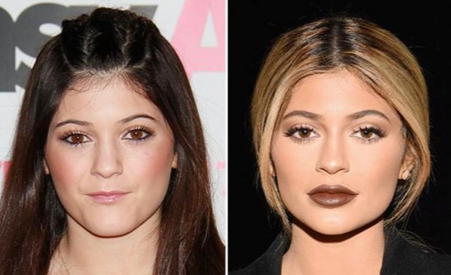 Lip Filler and Ducky Lips: How to Tell If You'll Look Ducky