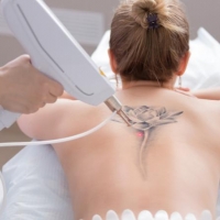 6 Reasons Why People Are Having Laser Tattoo Removal Utica NY