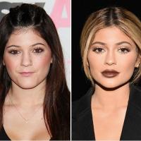 All About Lip Filler and How to Tell If You'll Look Ducky