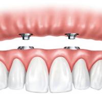 All You Need to Know About All-on-4 Implants