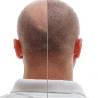 The Best Before and After Hair Transplant Pics