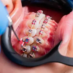 Can You Get Braces If You Have a Missing Tooth? Here’s What Dentists Say