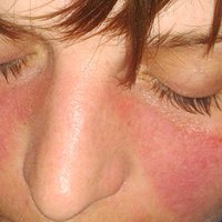 Lupus Skin Symptoms: A Closer Look