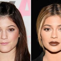 Lip Filler and Ducky Lips: How to Tell If You'll Look Ducky